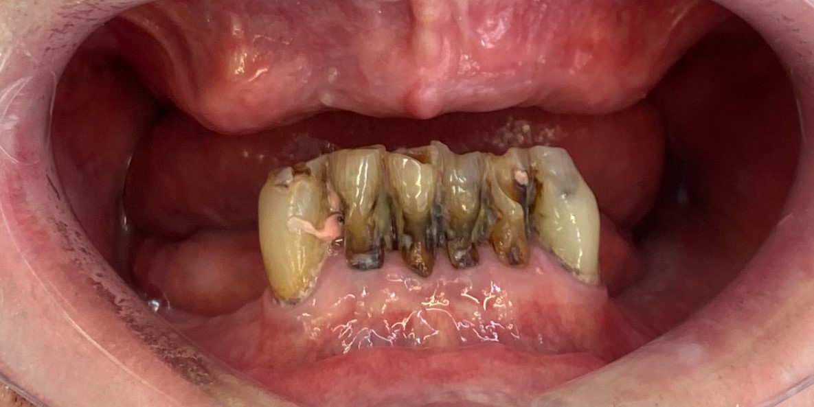 All on 4 Dental Implants (Before) (1) All on 4 Dental Implants (Before) (1)