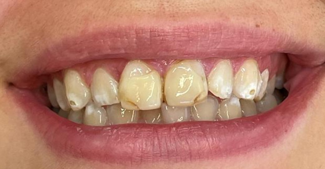 Composite Bonding (Before) Composite Bonding (Before)